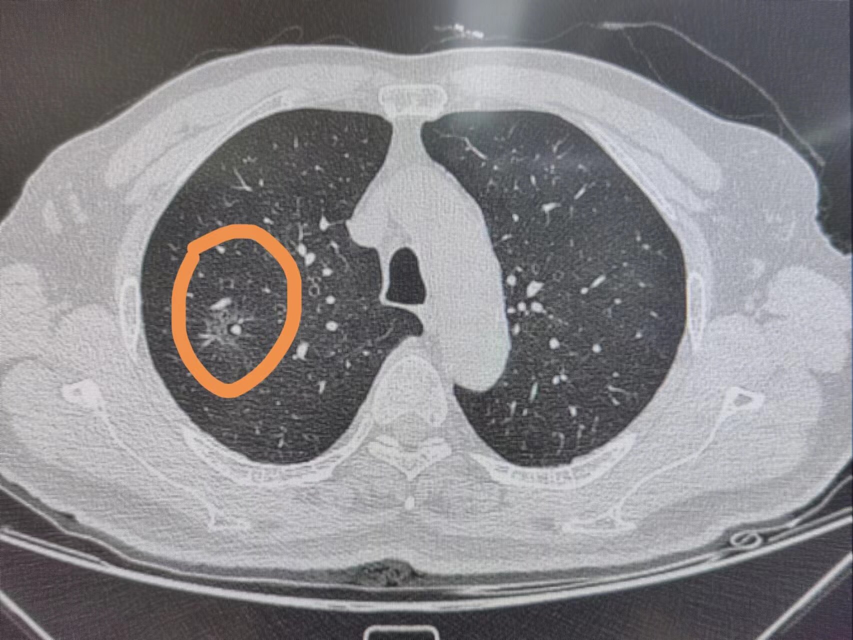 肺部5mm磨玻璃结节图片