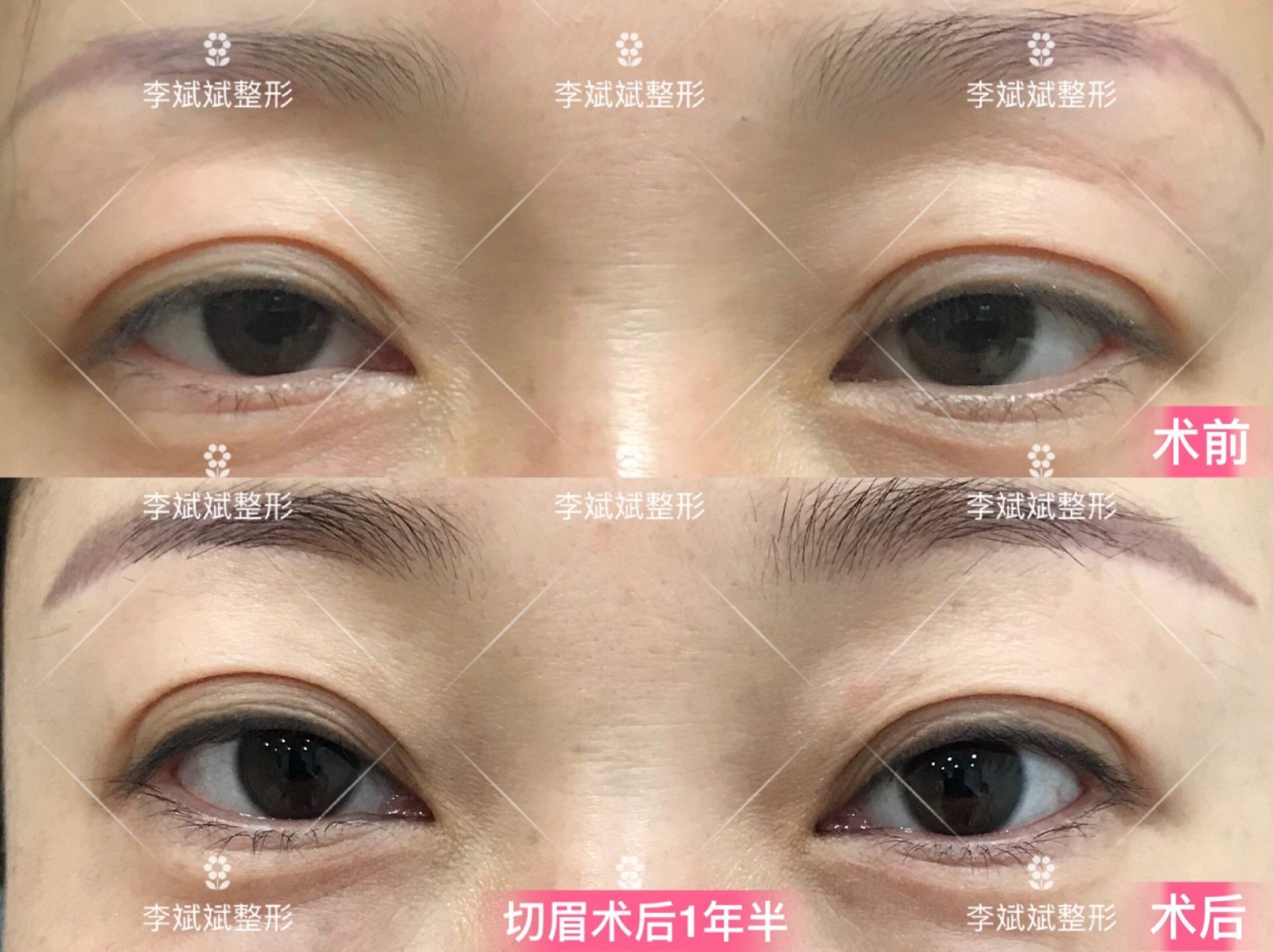 眼部整形_眼部整形治疗介绍 - 好大夫在线