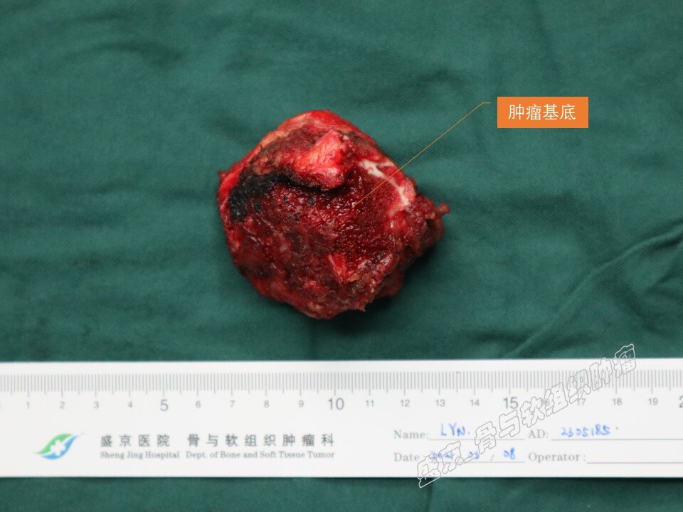 骨软骨瘤_骨软骨瘤治疗方式 - 好大夫在线