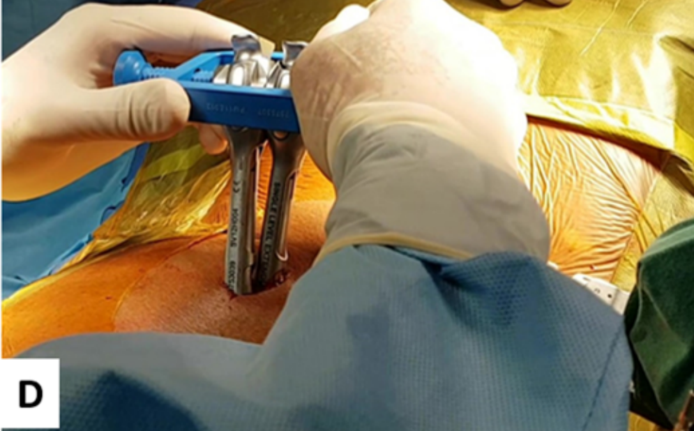 手术技巧丨当mis-tlif遇上Ⅱ度滑脱:摇摆复位法 - 好大夫在线