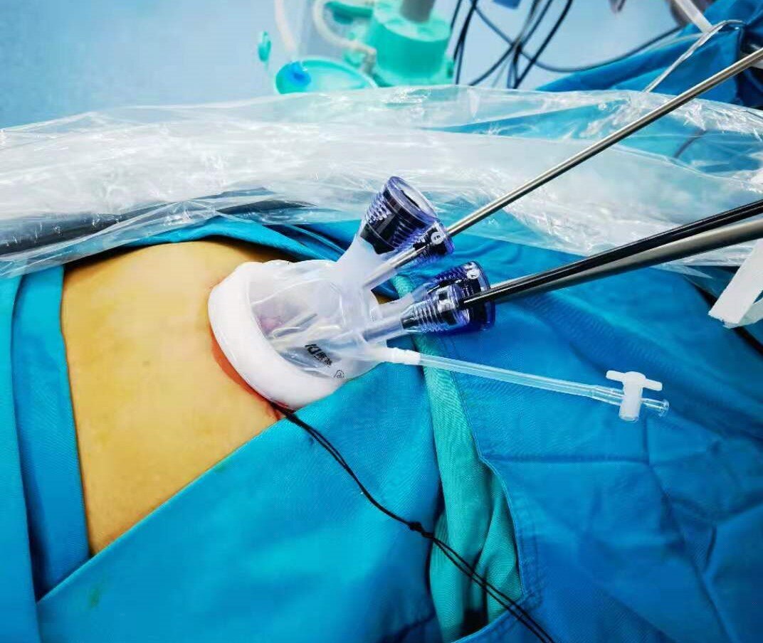 青岛妇女儿童医院城阳院区妇科开展单孔腹腔镜手术