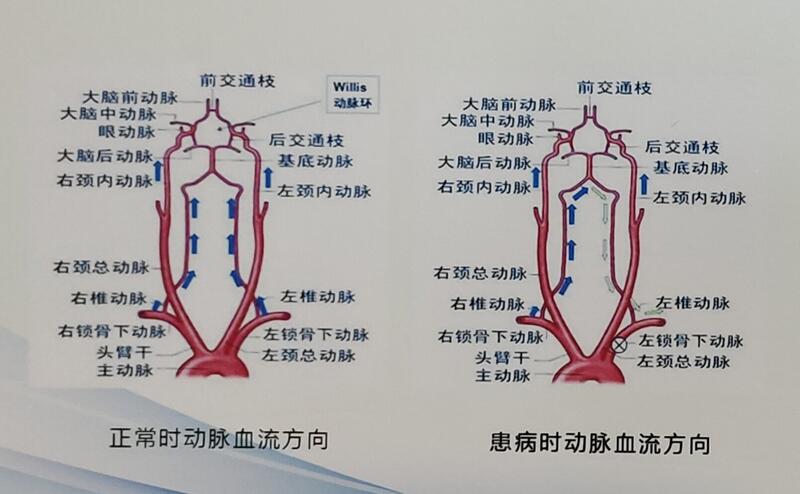 左锁骨下动脉远端图片