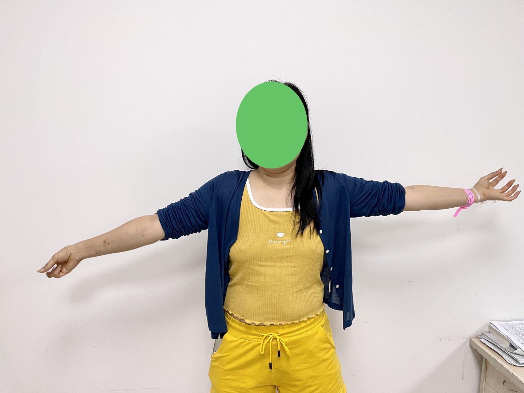 adson或斜角肌试验(adsons test)为阳性.