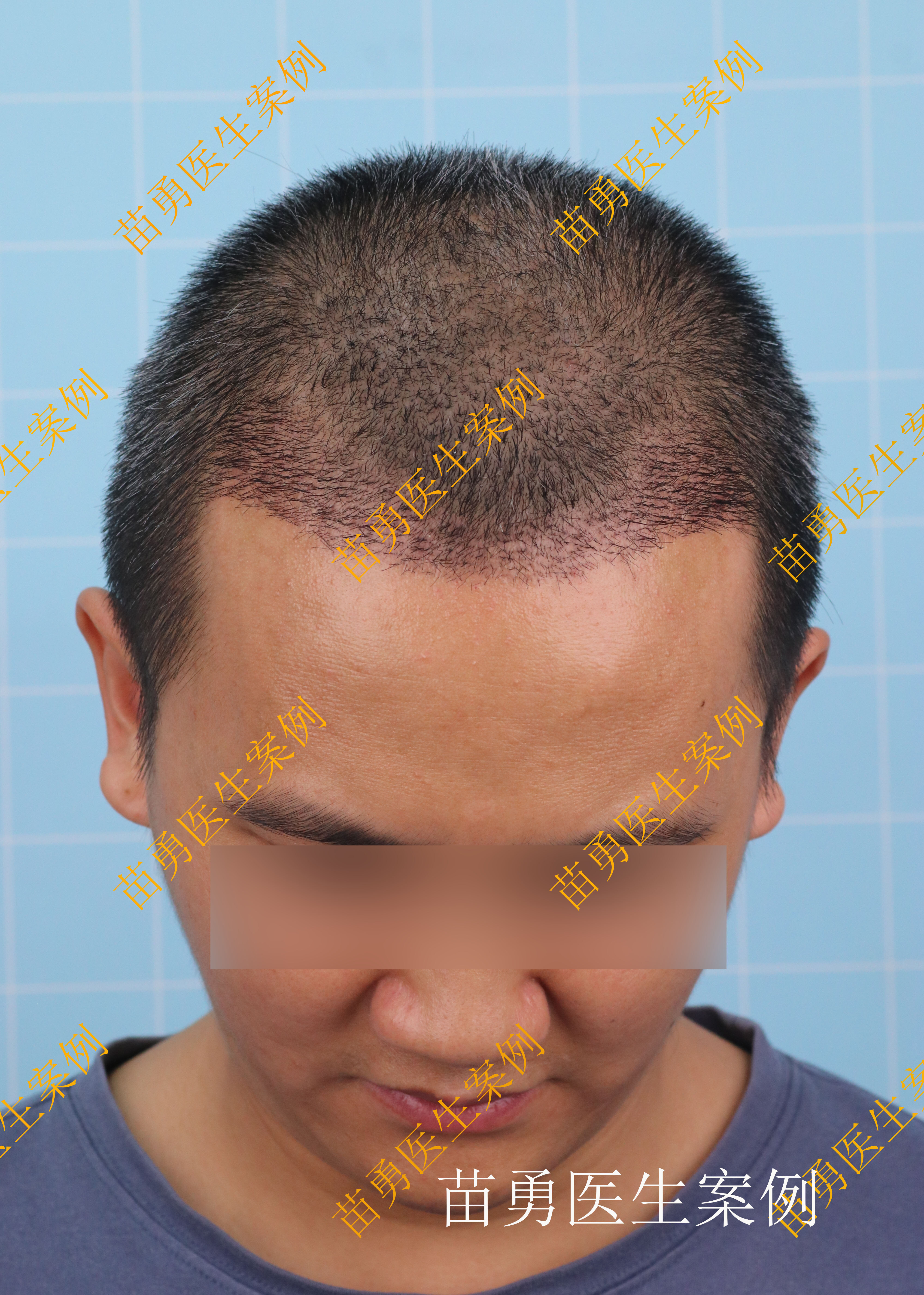 植发后工作生涯(做植发工作怎么样)