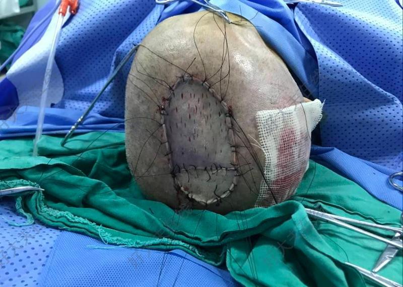 鳞癌切除植皮术