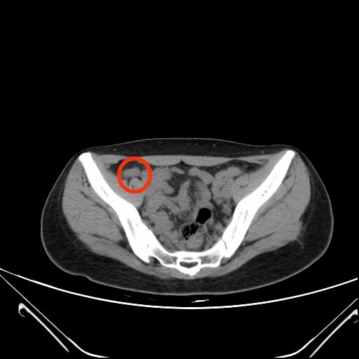 阑尾ct图片