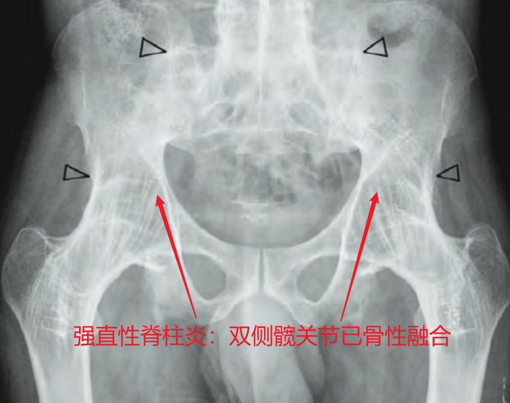 晚期的骨 关节炎Ⅳ期的股骨头坏死 类风湿 关节炎 导致髋关节