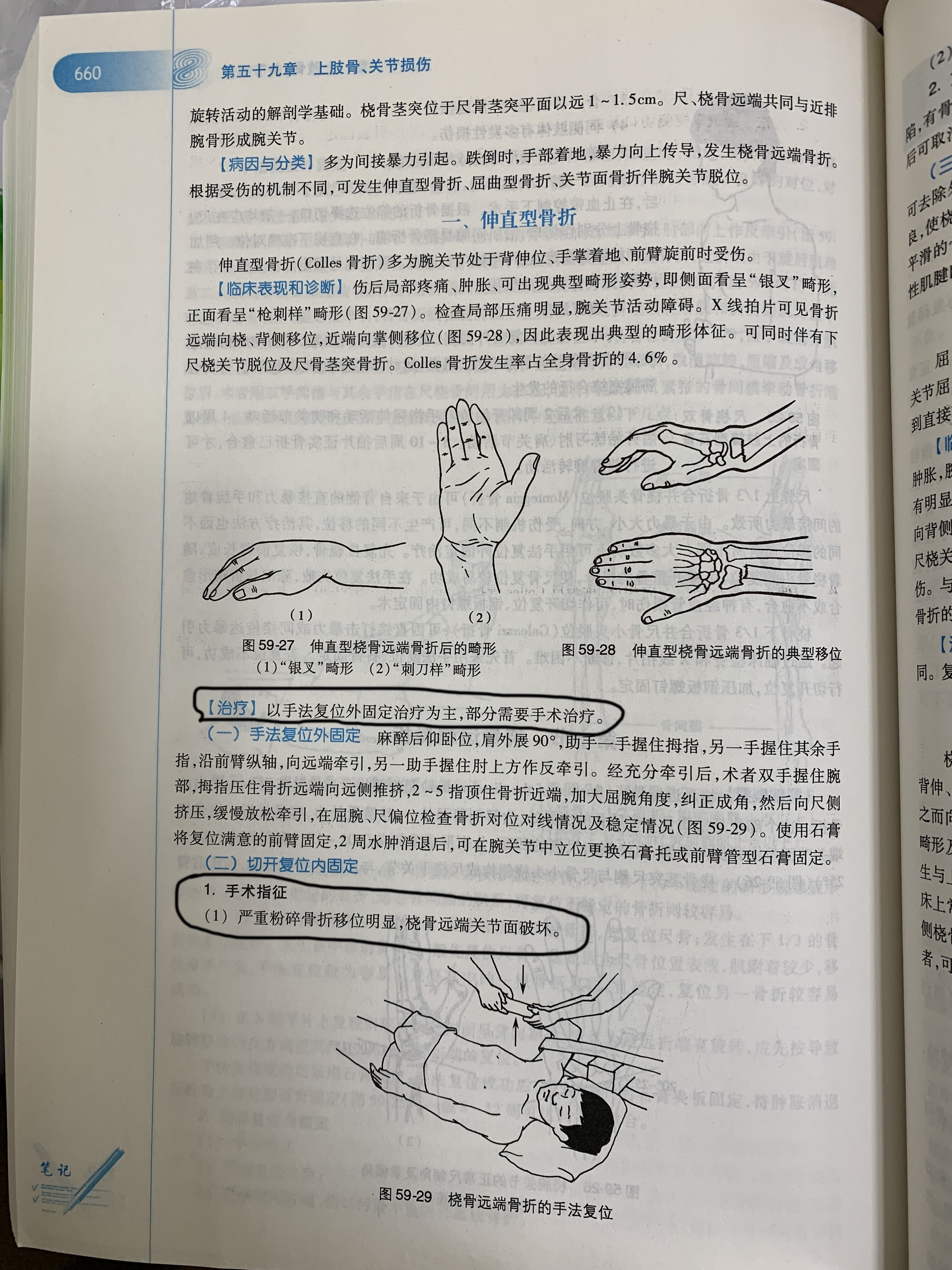 图10. 本科生教材桡骨远端骨折2a.jpg