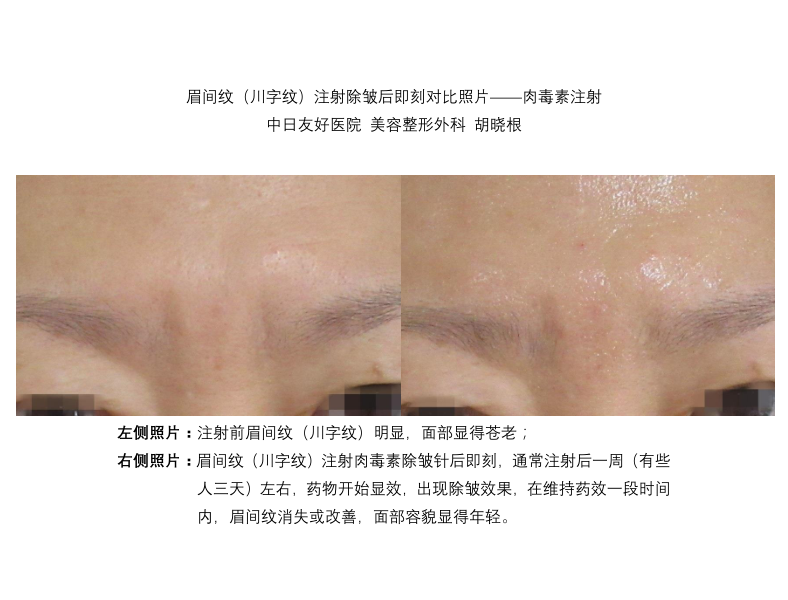 眉间纹(川字纹)注射除皱后即刻对比照片061——肉毒素注射.png