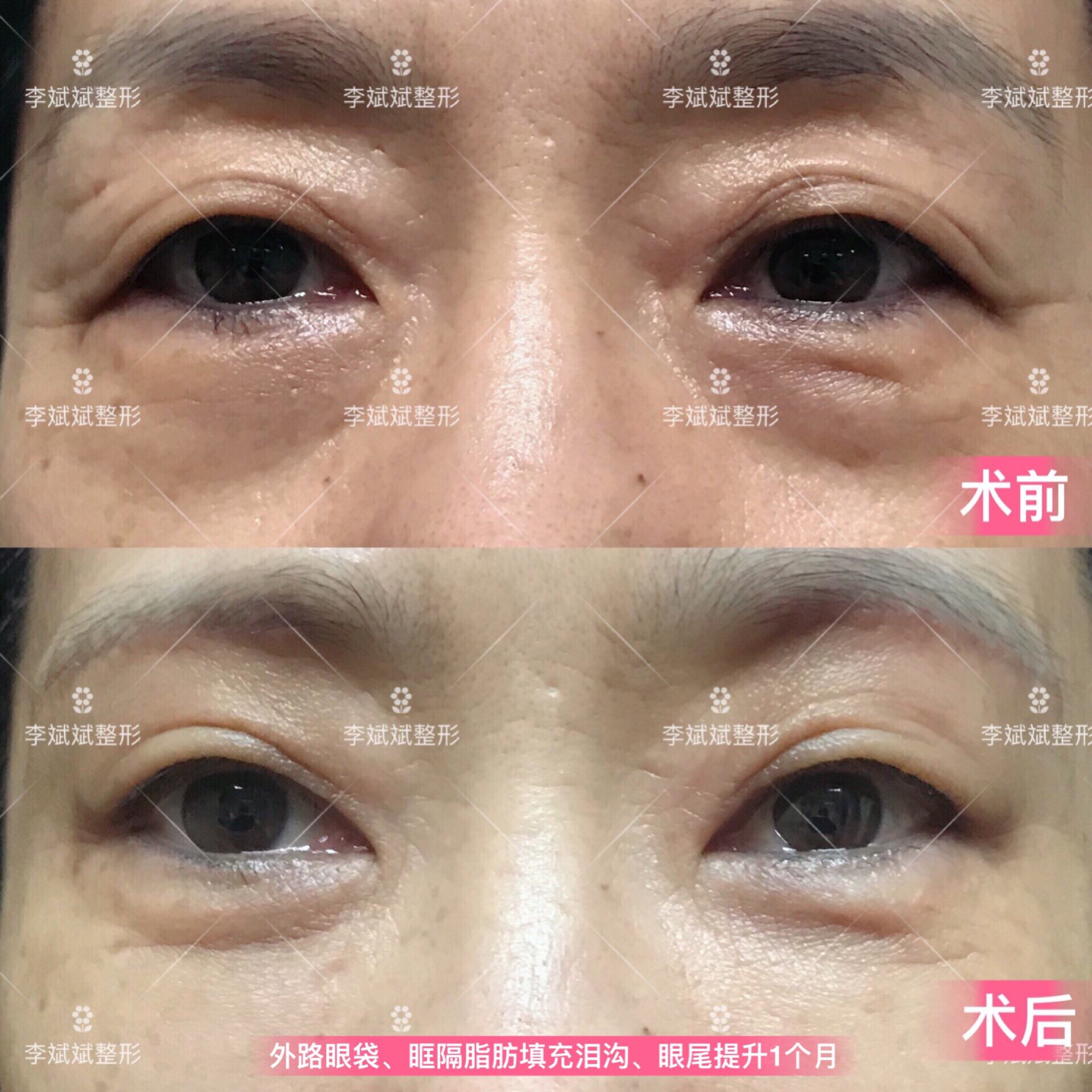 眼综合3 外路眼袋 切眉.jpg