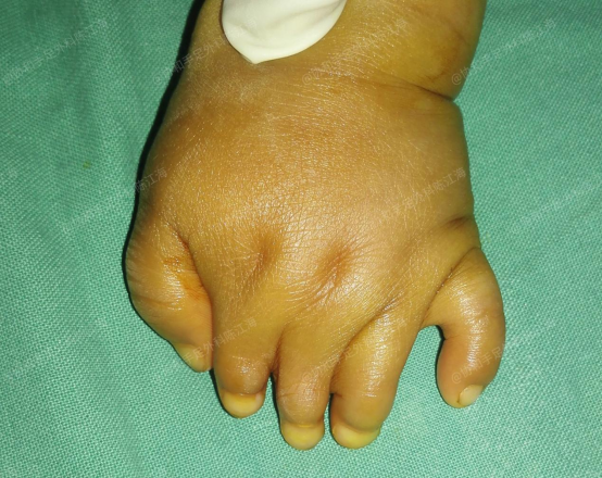 并指免植皮 | 案例6《孩子波兰综合征并指,手术做的早,术后外形和功能