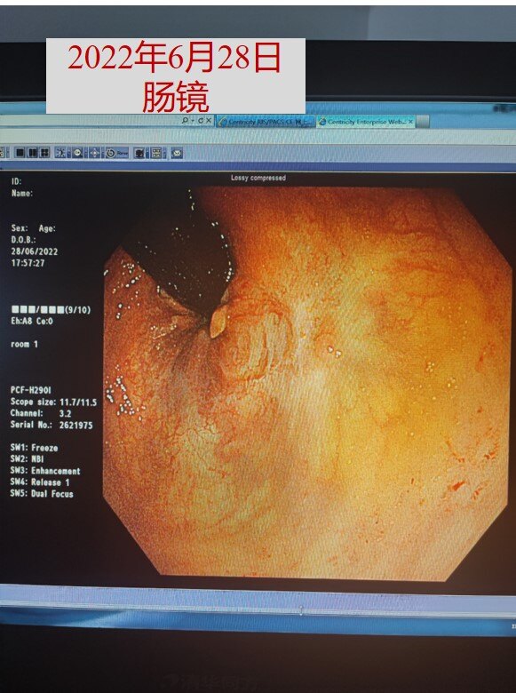 6月28日肠镜放大图.jpg