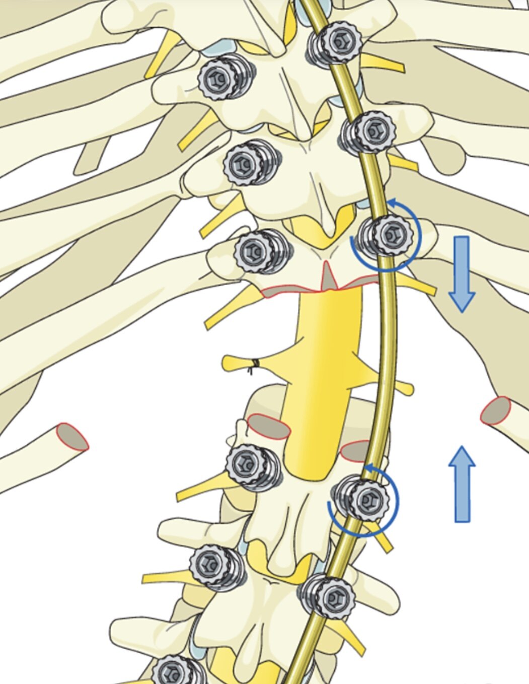 脊柱截骨矫形之vcr