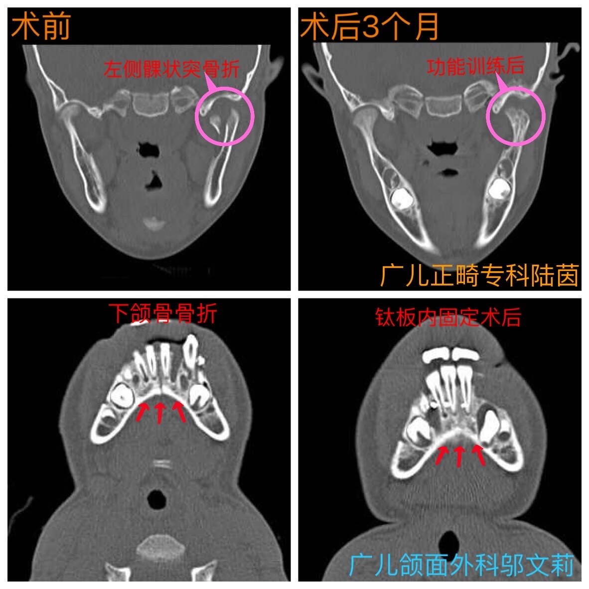下颌骨髁突骨折图解图片