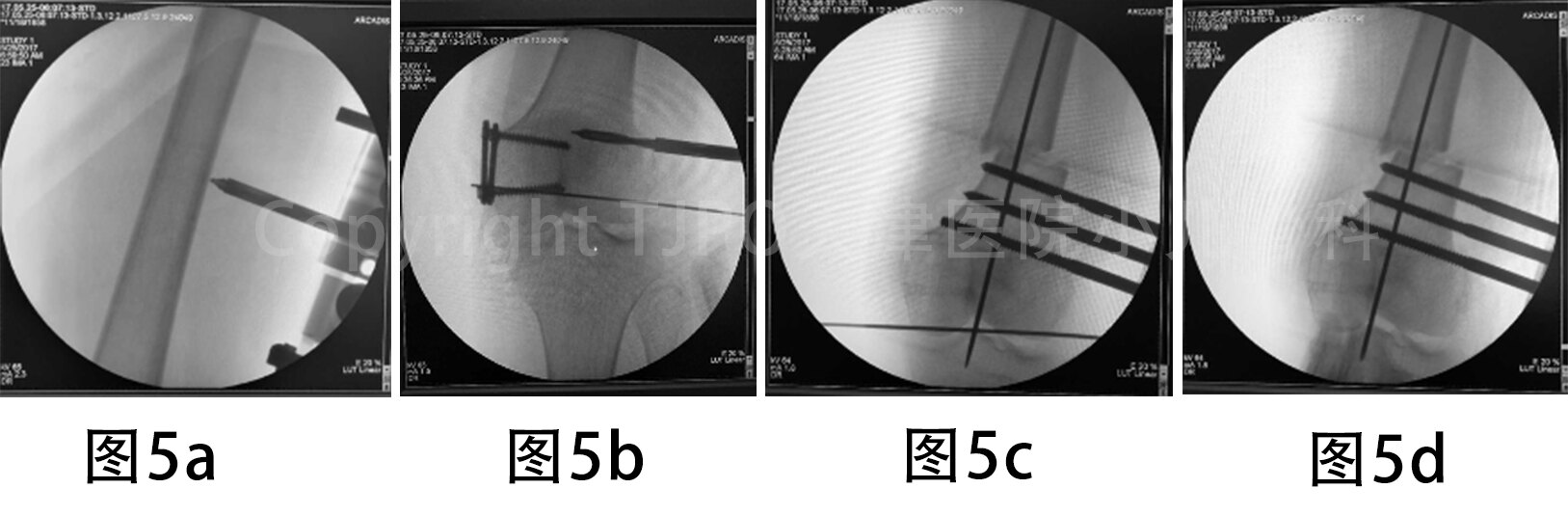 固定支架模塊確定最近端半釘位置,將第一枚半釘垂直股骨幹解剖軸置入