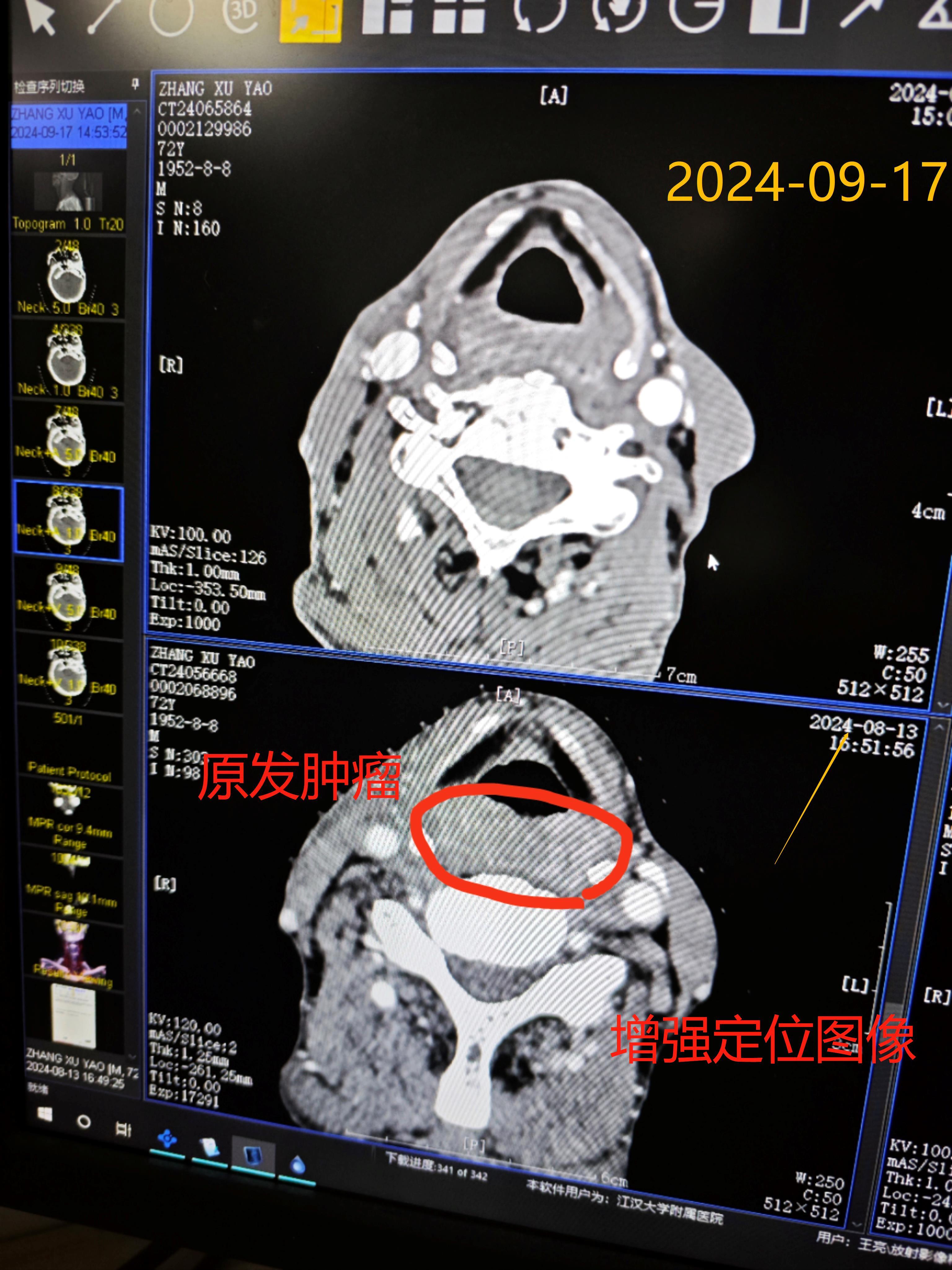 下咽癌以局部治疗为先导的综合治疗