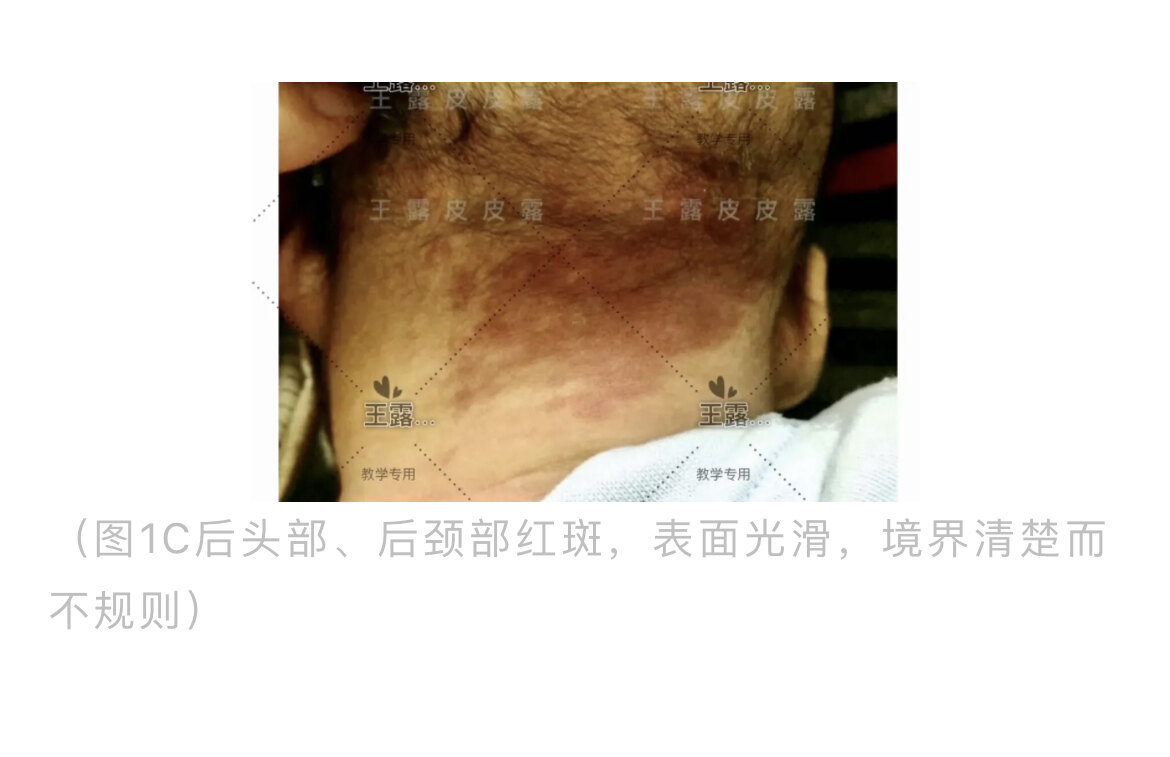 家长眼中的胎记(一)鲑鱼色斑_胎记_胎记介绍 - 好大夫在线