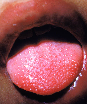 猩红热舌头图片图片