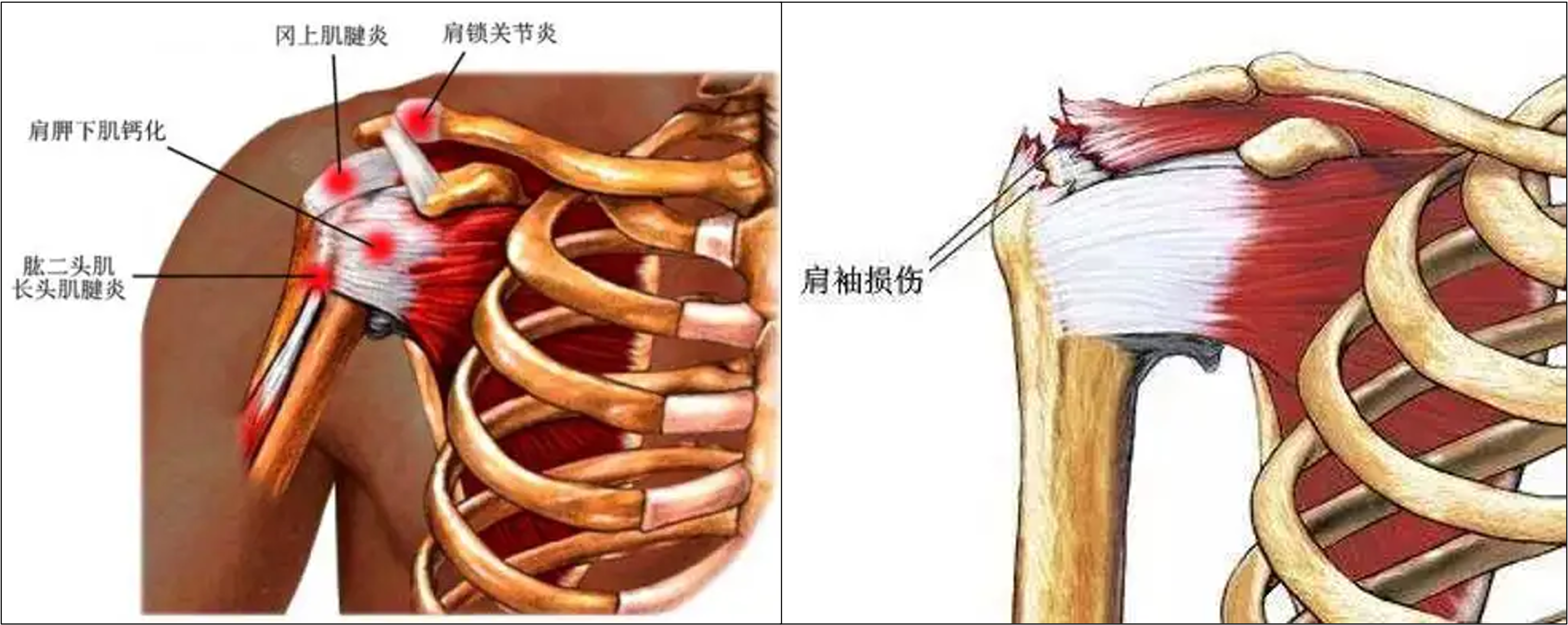 包括肩袖損傷,肩周炎,肩峰下撞擊綜合症,肱二頭肌長頭肌腱炎,鈣化性