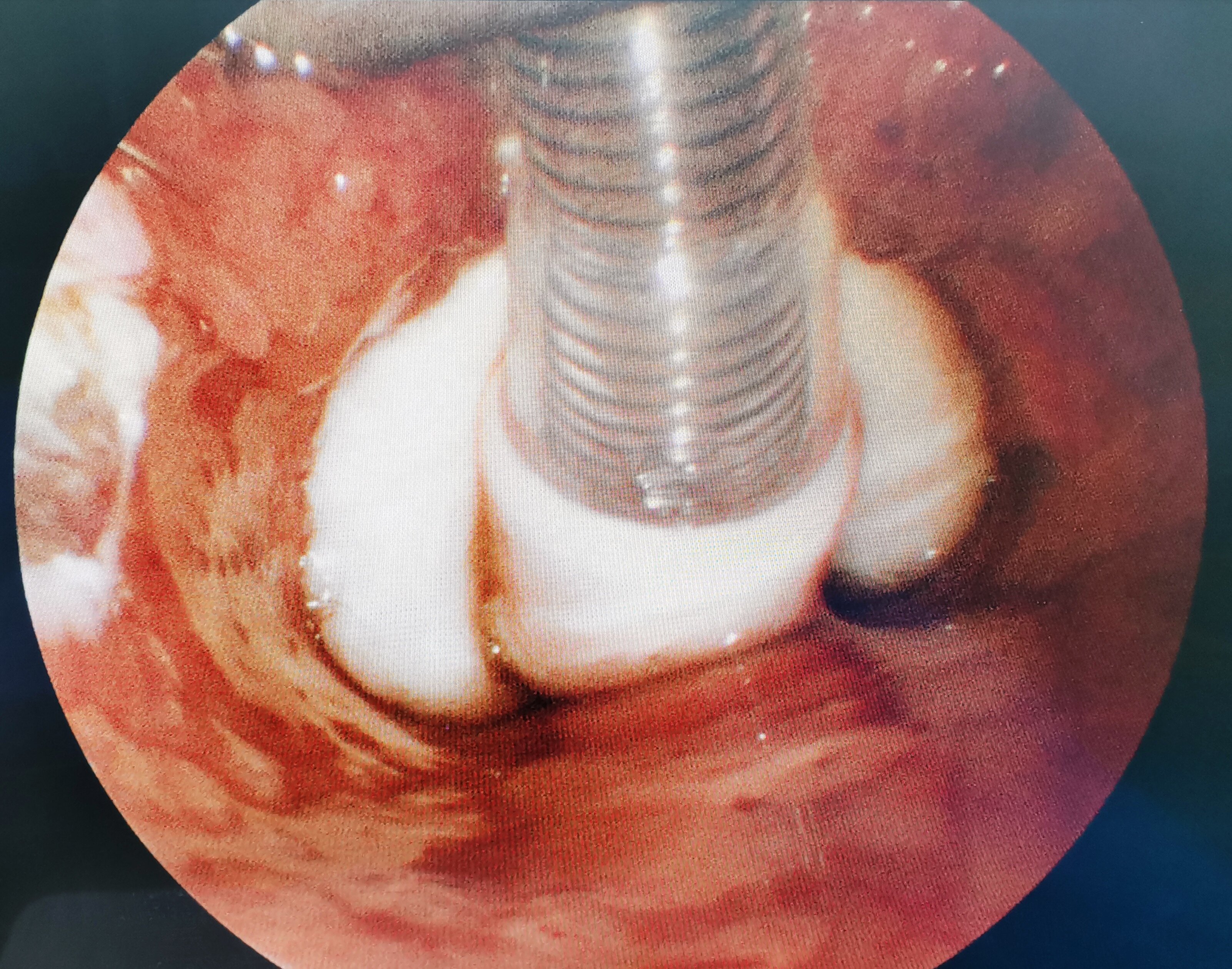 做扁桃体和腺样体手术会影响声带吗?