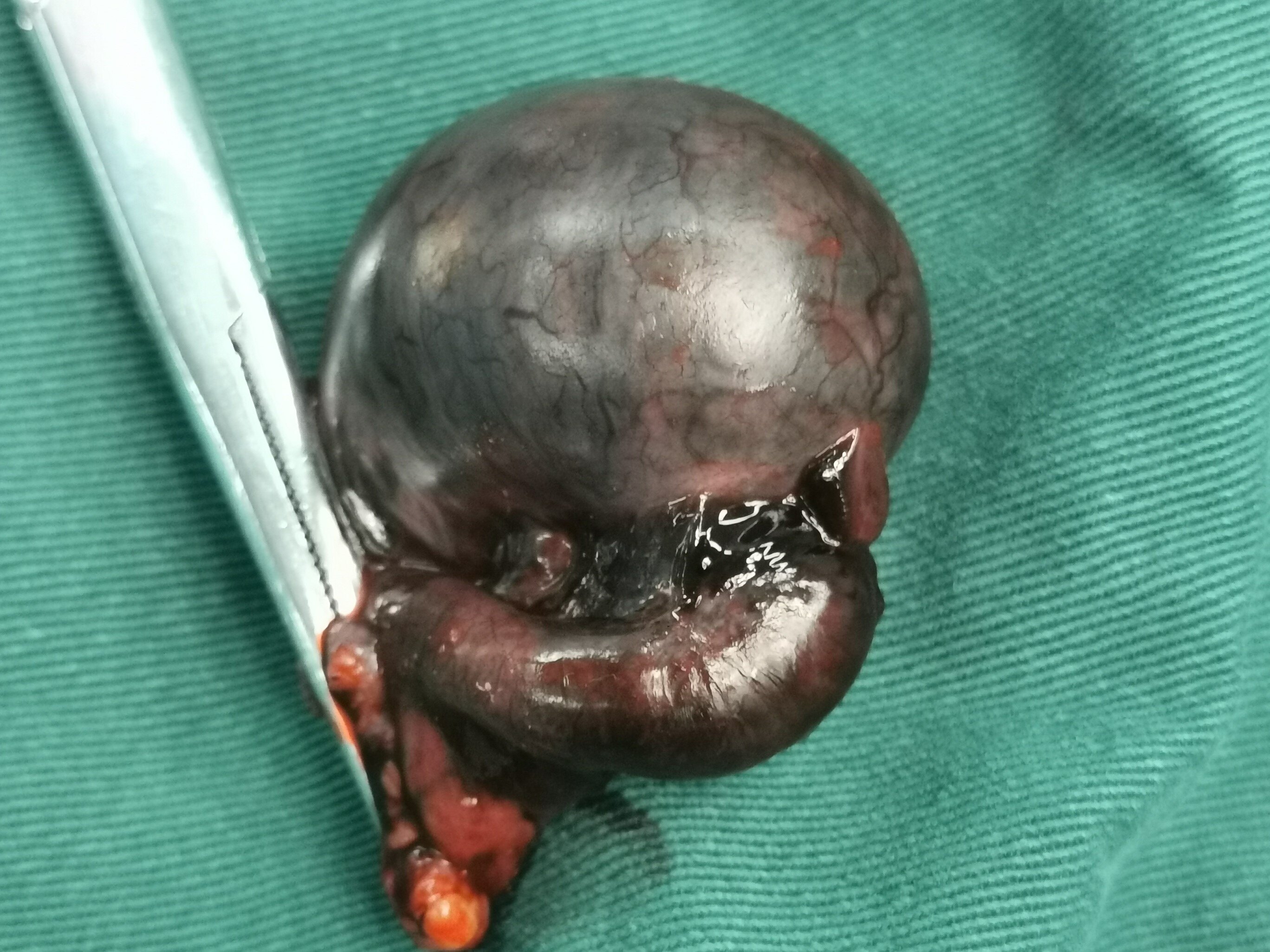 造成精索内血液循环障碍,引起睾丸缺血,坏死