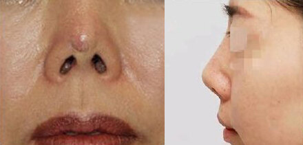 ②挛缩:如果鼻子已经出现挛缩,出现鼻头朝天的问题.