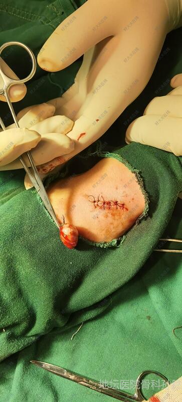 左腕部肿物完整切除术