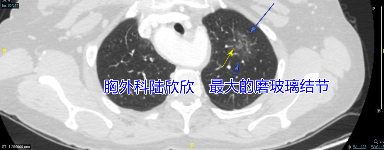 左上1薄层65小空洞副本.jpg