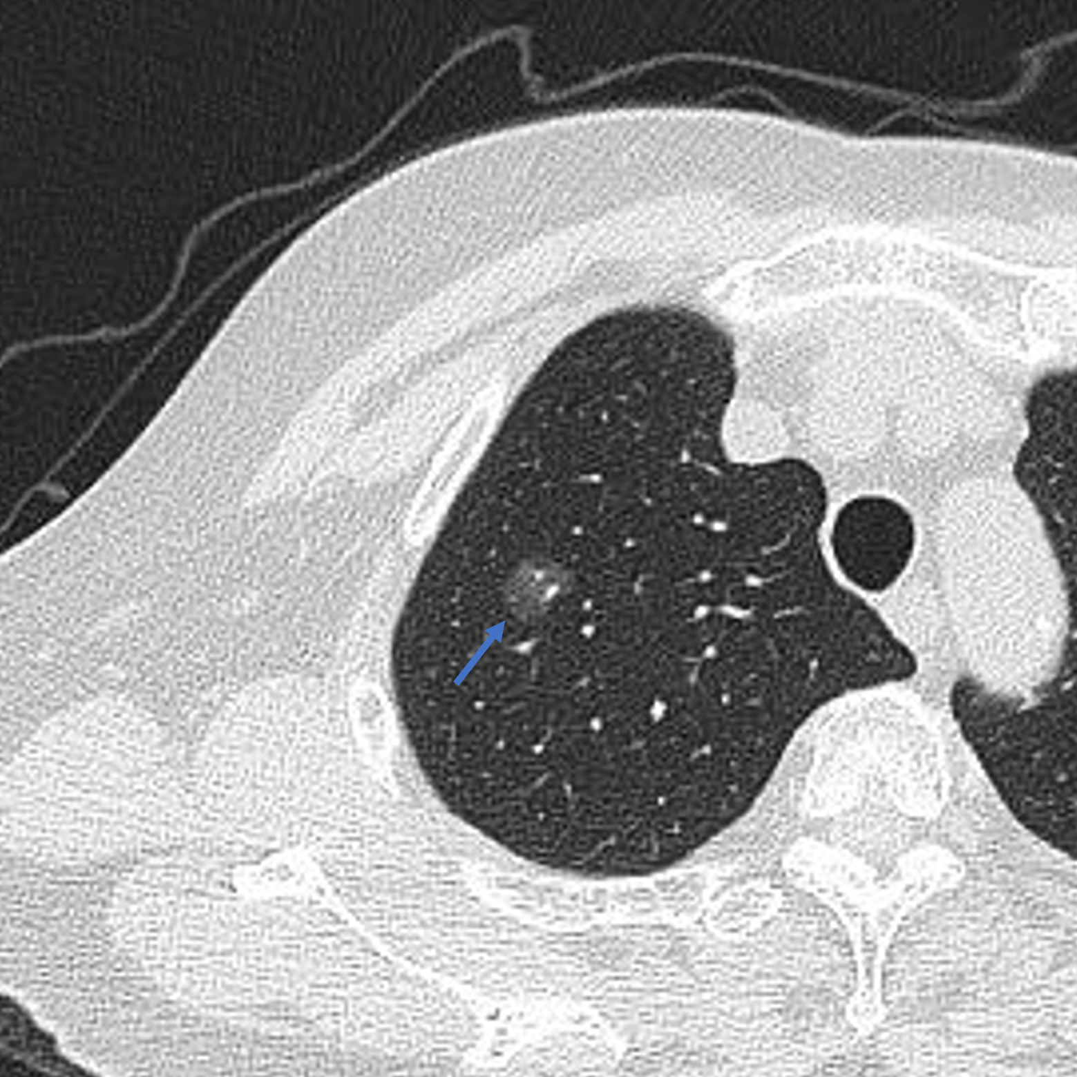 近期有两位乳腺癌的患者,在胸部ct扫描时发现了肺内多发磨玻璃结节,第