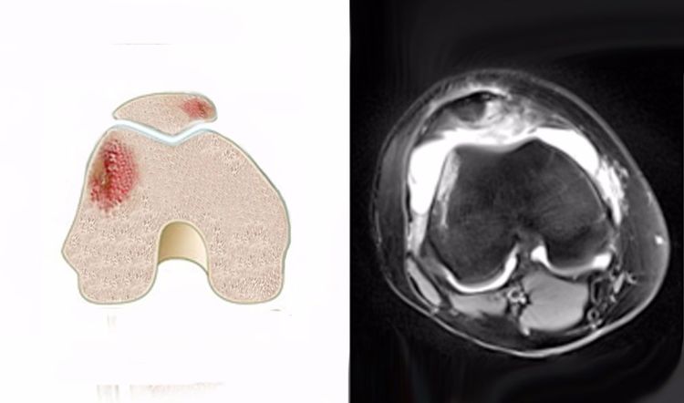 膝关节外伤性骨髓水肿