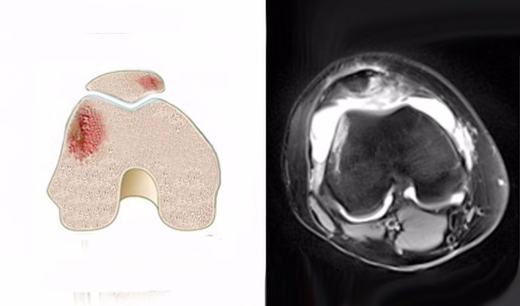 膝关节外伤性骨髓水肿 膝关节外伤性骨髓水肿