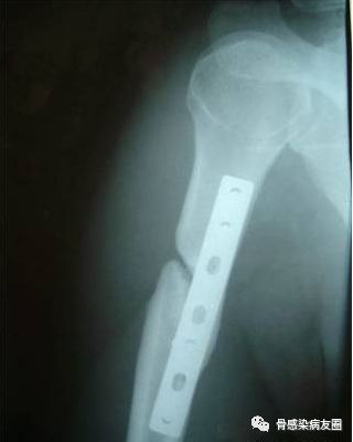 疾病科普(2)骨折不愈合的原因是什么? 怎么预防? - 好大夫在线