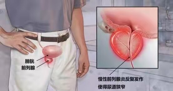前列腺在人体的位置图片