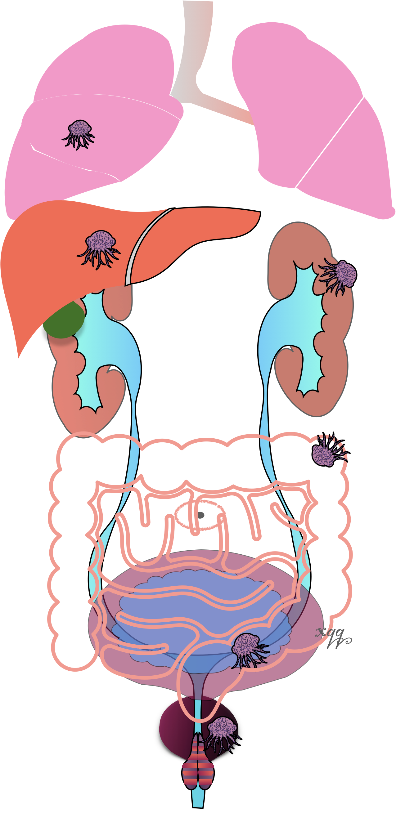 人多处长肿瘤是怎么回事?