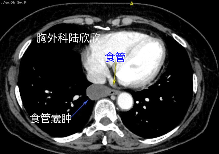 食管囊肿水印.jpg