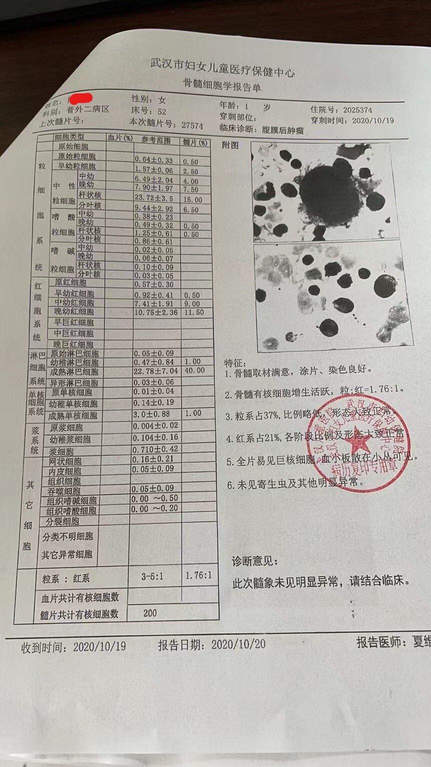 多发性骨髓瘤病理报告图片