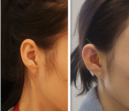 贴发耳的矫正_耳部整形 - 好大夫在线