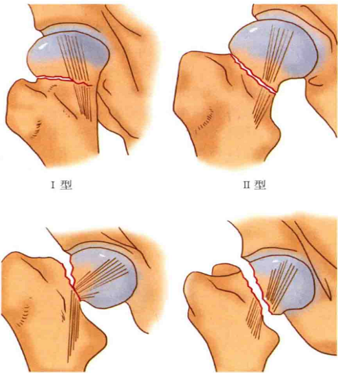 粗隆间骨折分型图片图片