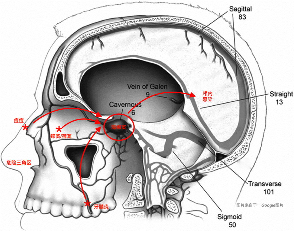 Tooth-abscess-cavernous-sinus-chicago-1024x802.jpg