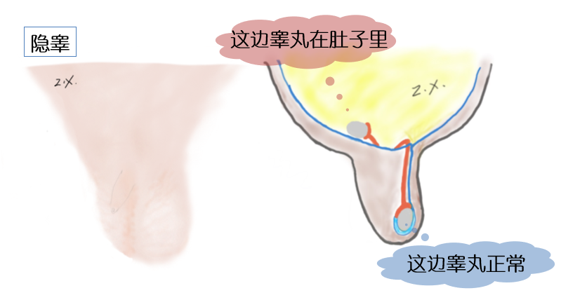 寶寶兩邊蛋蛋不一樣大這是怎麼回事