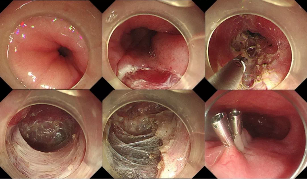 吞咽困难的原因可能是它——贲门失弛缓症_贲门失弛缓症_介绍_发病