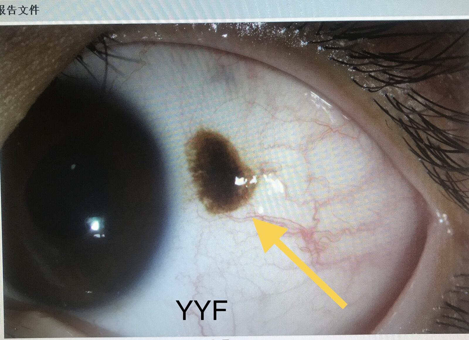 341結膜色素痣還是結膜黑變病表現其實有差別最終確定靠病理