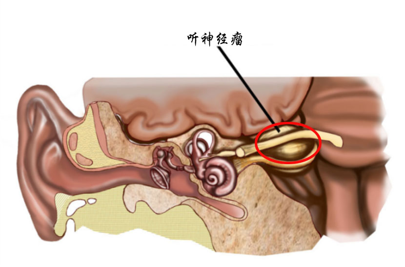 肿瘤综合征,一种因内听道前庭神经鞘膜细胞异常增殖导致的良性肿瘤,最