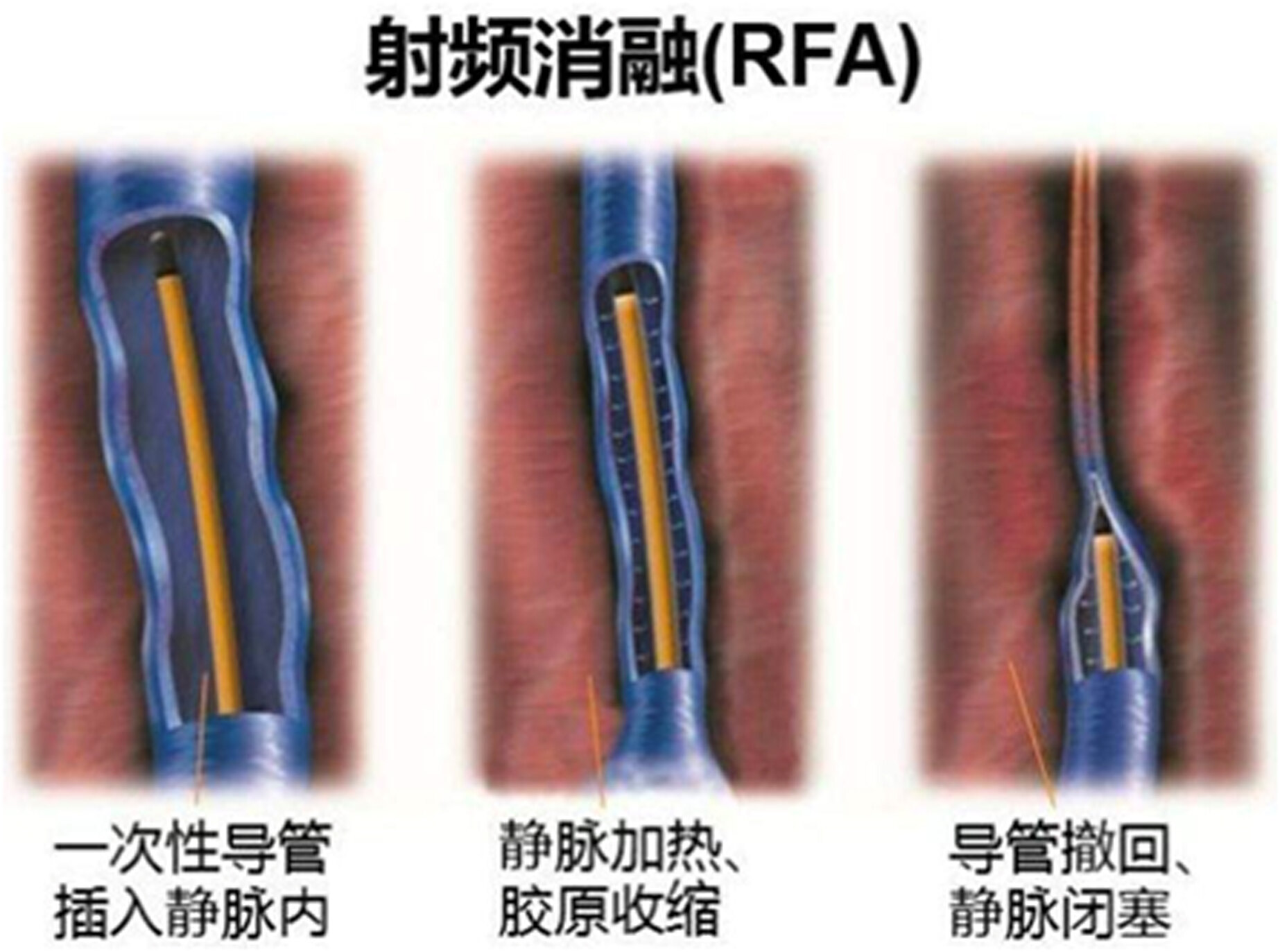 射频消融JPG.jpg