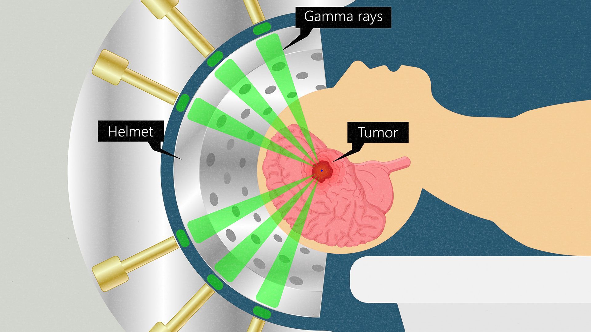 cancer-news-stereotactic-therapy-is-best-for-brain