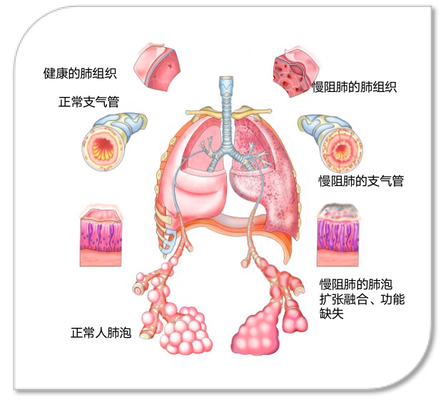 慢阻肺的病因图片