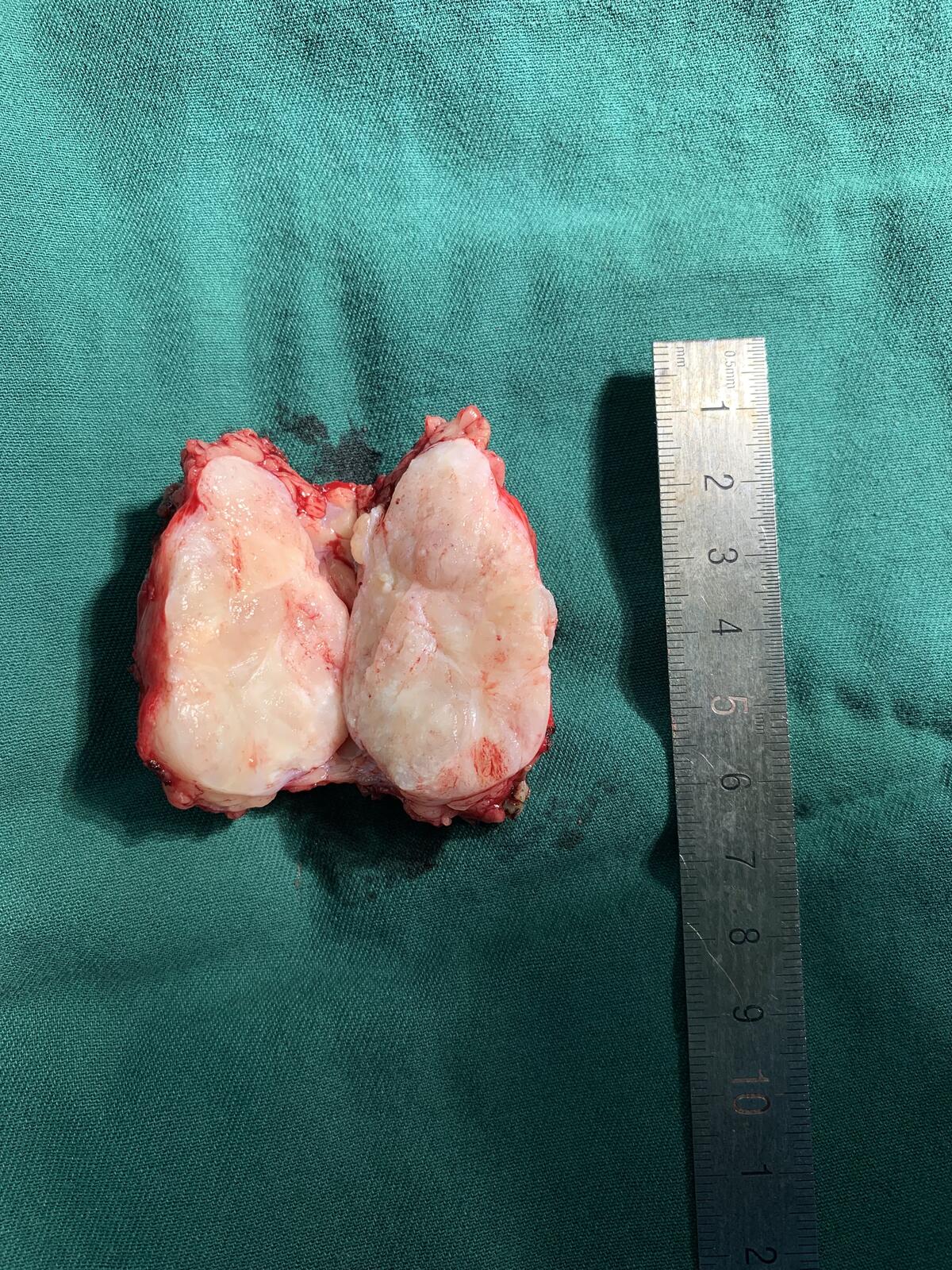 腺性瘤息肉手术后图片图片