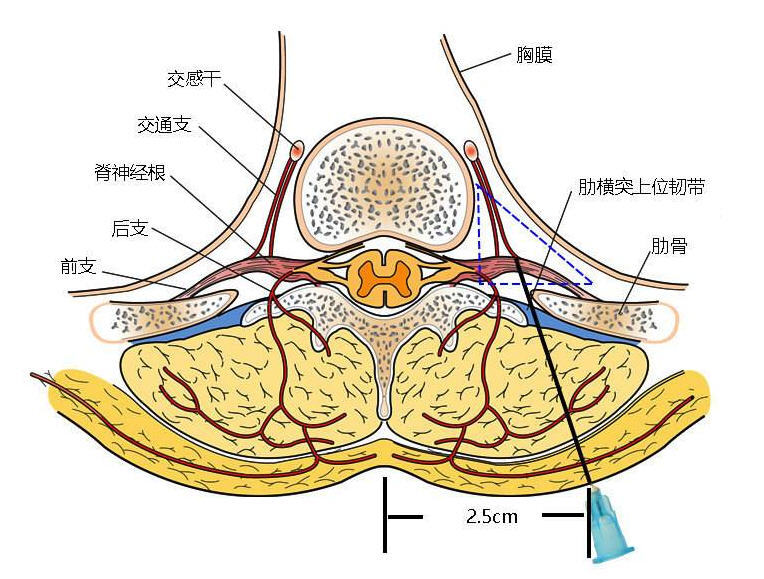 侧锥筋膜解剖位置图片