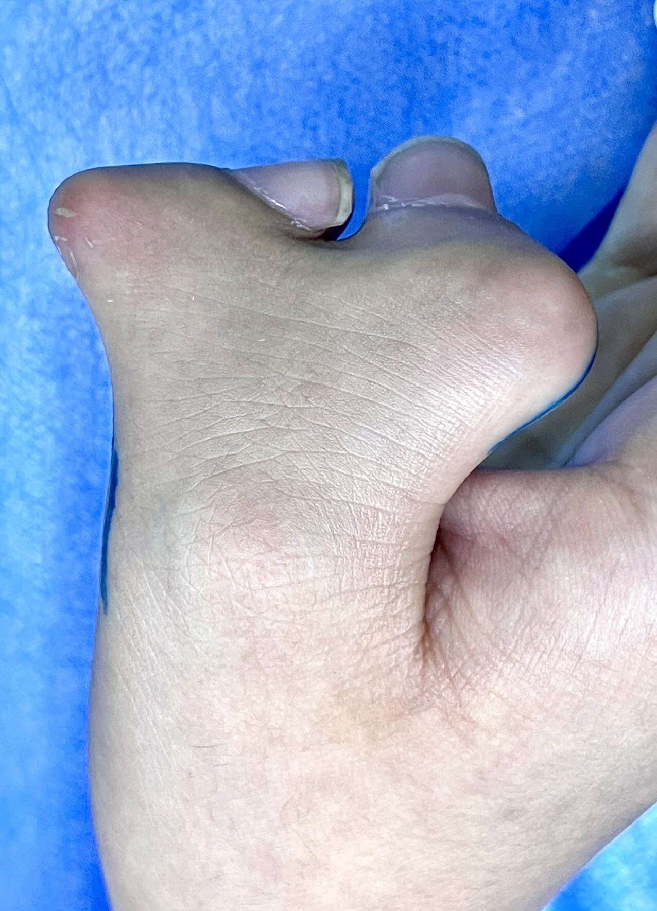 术前资料:xxx 男 13岁 左拇蟹钳样复拇指畸形 wassel 三型一,病例资料