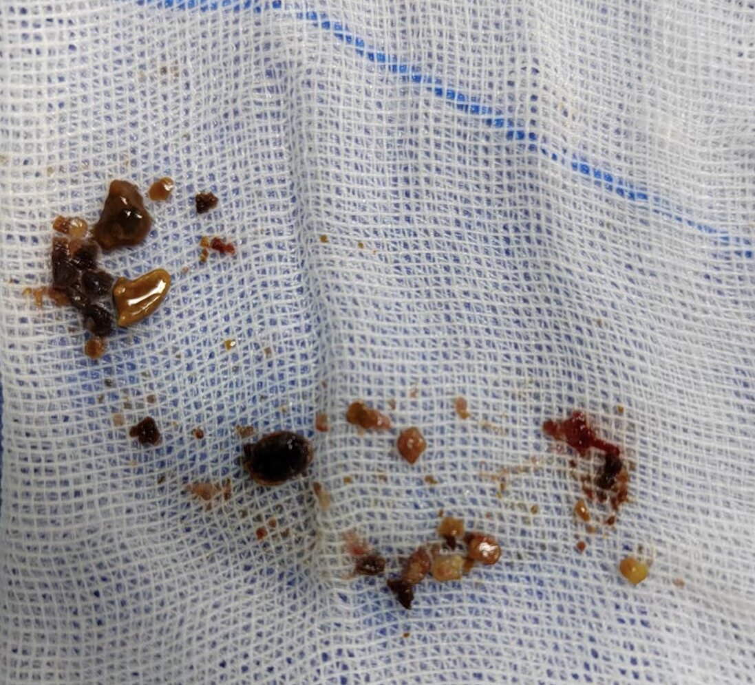 困扰患者十年的"血精"今天终于在精囊镜下罗找到了元凶——射精管结石